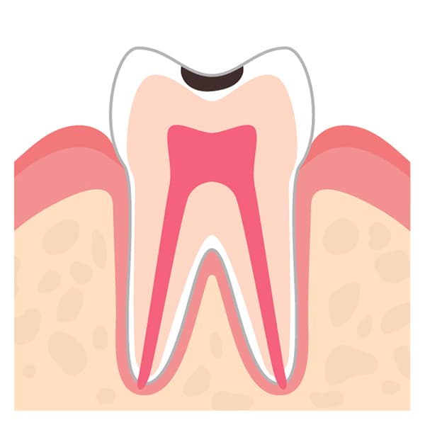 むし歯の進行度 C1