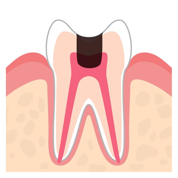 むし歯の進行度 C3